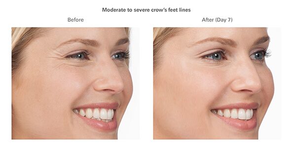 botox-before-after-sandra