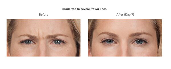 botox-before-after-sandra1