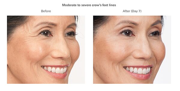 botox-before-after-susan