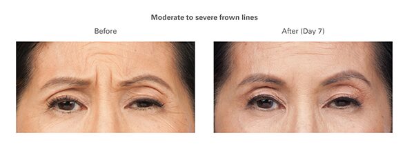 botox-before-after-susan1