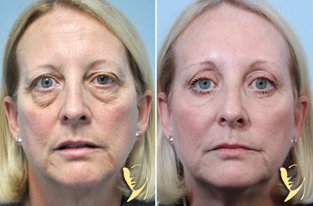 brow lift - lower blepharoplasty- erbium laser resurfacing to lower eyelids