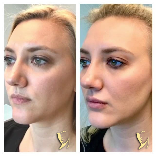 chin filler before and after