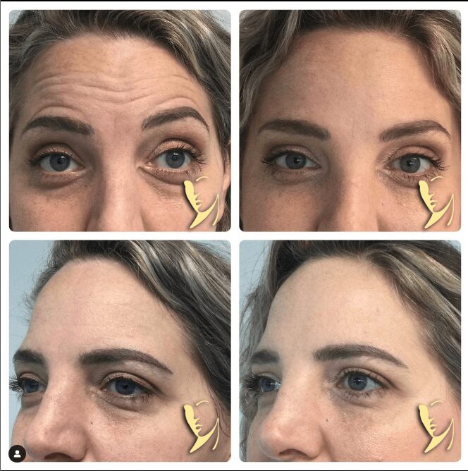 before and after