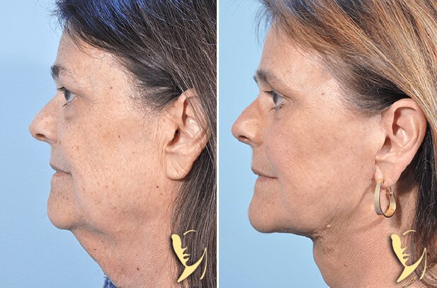 facelift before and after