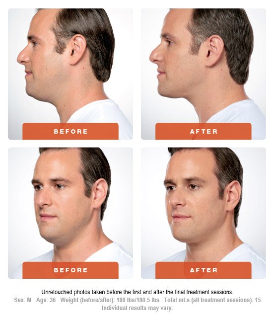 kybella-before-after-1