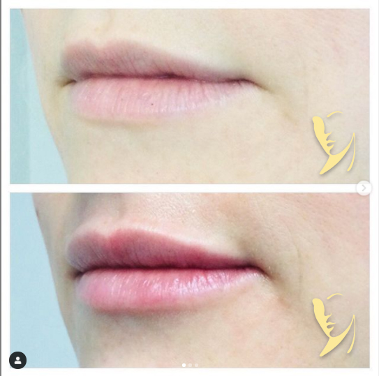 lip-enhancement