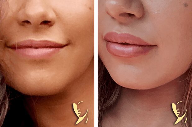 Before and after lip enhancement comparison.