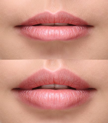 lip enhancement before after