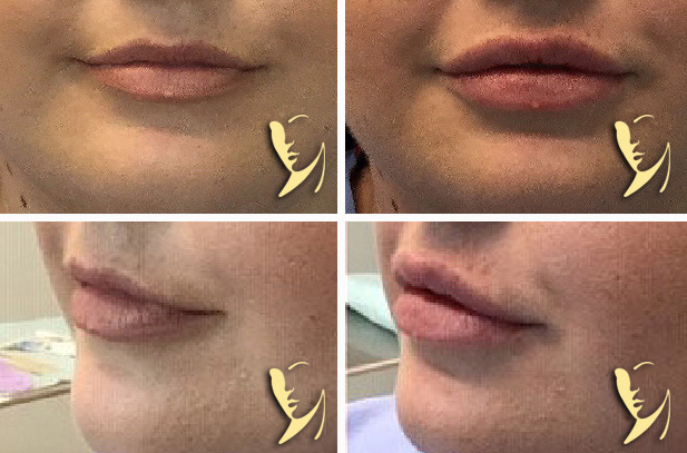 lip-enhancement