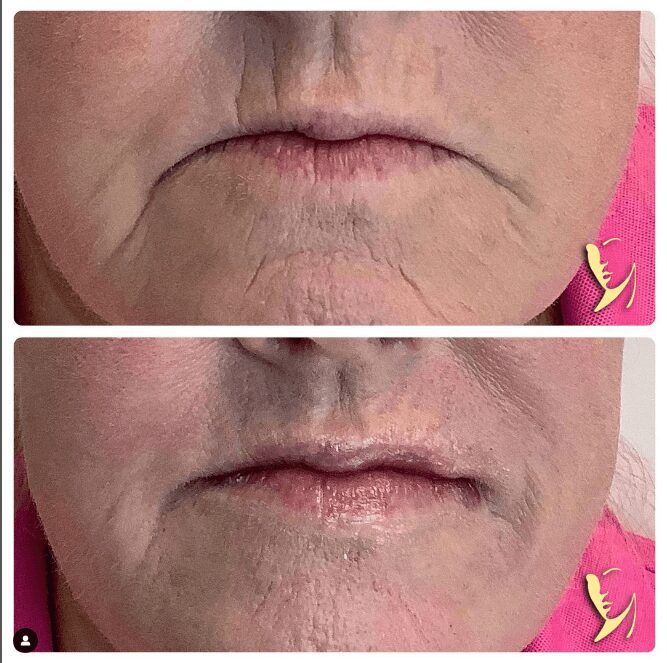 before and after