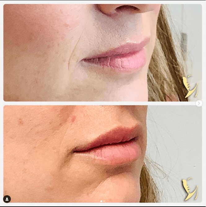 before and after