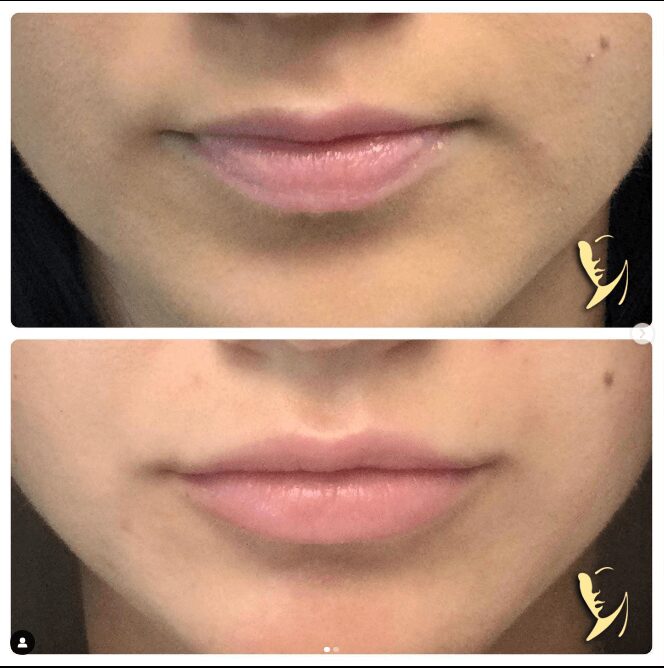before and after