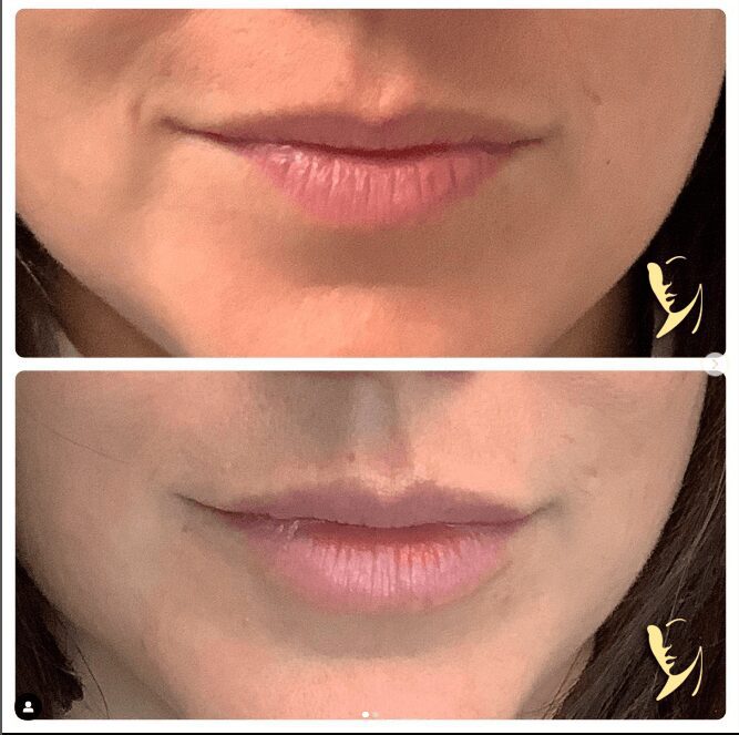 before and after