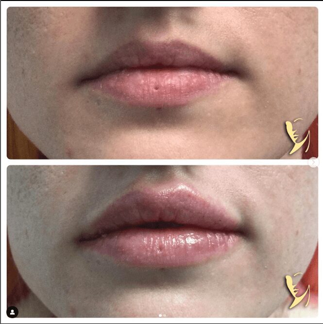 before and after