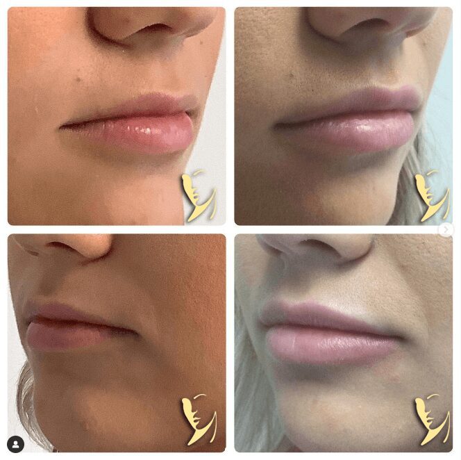 before and after