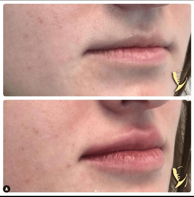 before and after