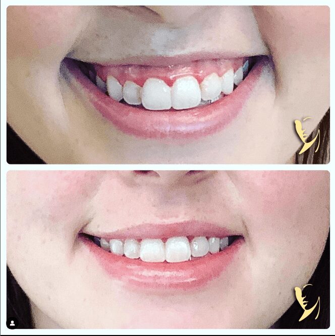 before and after