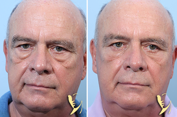 lower-eyelids-blepharoplasty-before-after-30