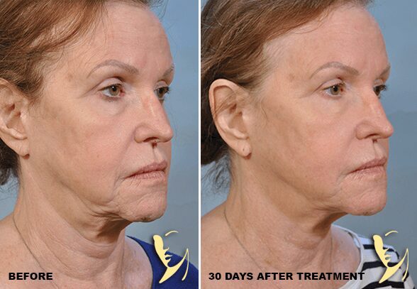 profound-lift-before-and-after-1