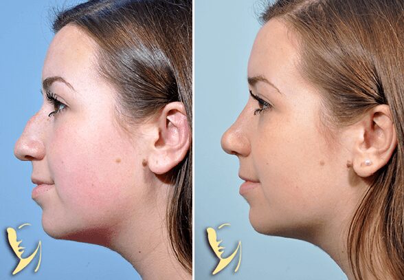 rhinoplasty before and after