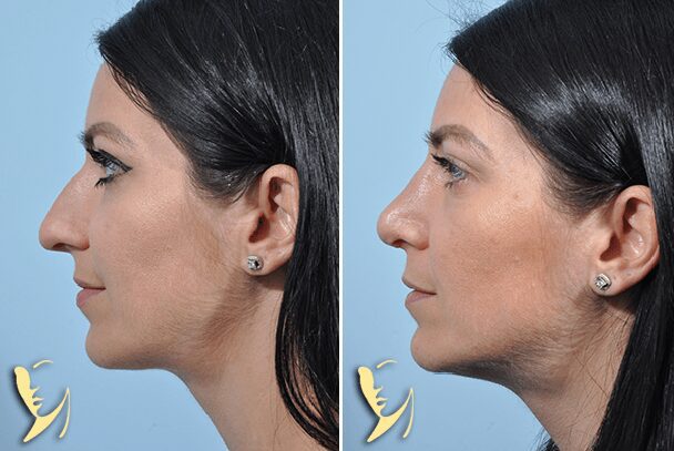 rhinoplasty before and after