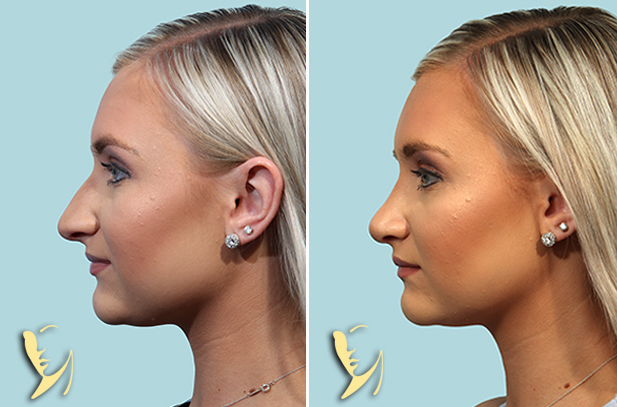 rhinoplasty before after 135