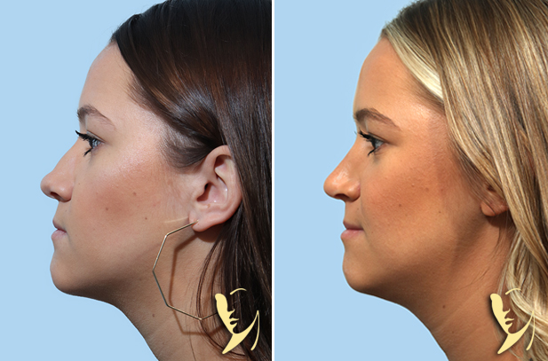 rhinoplasty before after 170