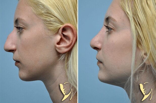 rhinoplasty-before-after-50