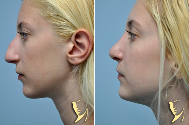 rhinoplasty-before-after-50