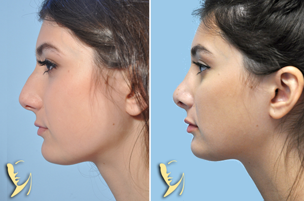 rhinoplasty-before-after-60-1