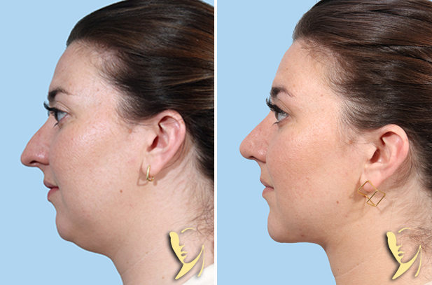 rhinoplasty, chin augmentation, submental lipectomy with platysmaplasty before after side view