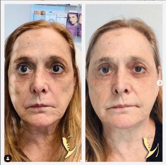 Before and after cosmetic treatment comparison.