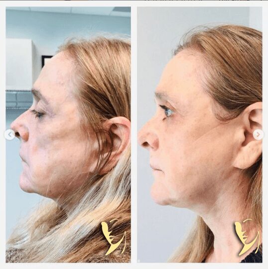 Side profile comparison of woman before, after.