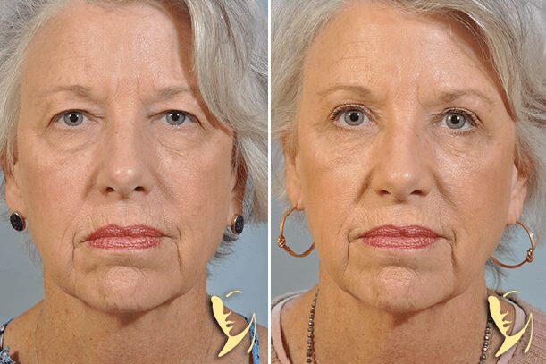 upper and lower eyelid surgery 34